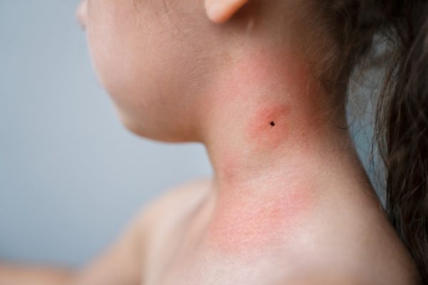 Căpușele, risc pentru sănătate. Ce pași trebuie urmați după o mușcătură și când mergeți la medic